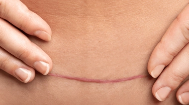 Masser une cicatrice permet de redonner de l'élasticité à la peau