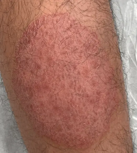 Des plaques rouges peuvent apparaître sur différentes parties du corps