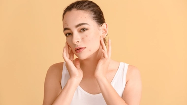 L'acné persistant à l'âge adulte se traite de la même manière que celle apparaissant à l'adolescence