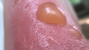 Aussi appelée "dermite des prés", la phytophotodermatose peut provoquer d'impressionnantes cloques