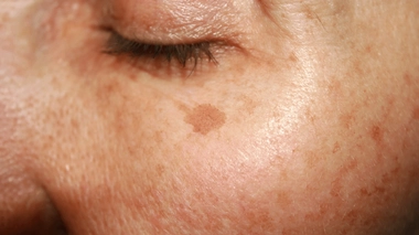 Les taches brunes apparaissent sur les zones les plus exposées au soleil