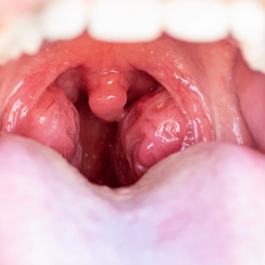 L'angine correspond à une inflammation des amygdales