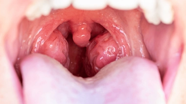 L'angine correspond à une inflammation des amygdales