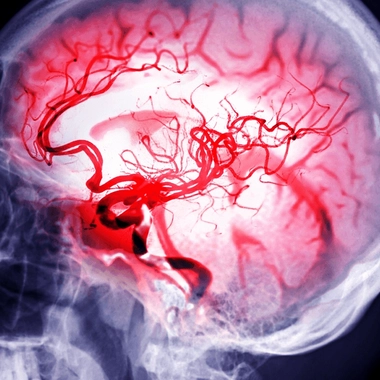 Si un anévrisme se rompt, il entraîne des conséquences sévères, souvent fatales