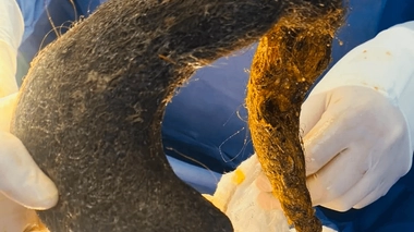 La boule de cheveux retirée de l'estomac de la patiente mesurait 40 cm de long et pesait environ 1 kg