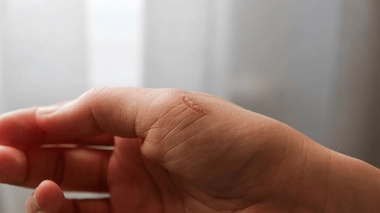 Les blessures profondes laissent des cicatrices