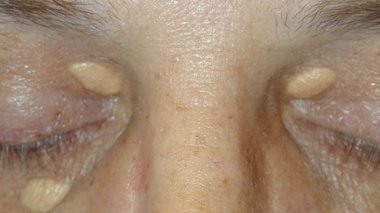 Paupières jaunes : alerte à la crise cardiaque