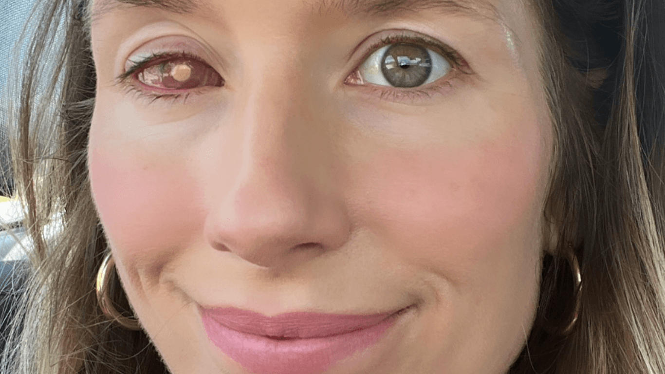 Une femme devient aveugle après s'être douchée avec ses lentilles de ...