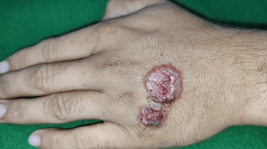 La leishmaniose peut se caractériser par des affections cutanées