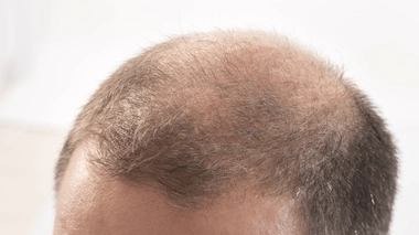 Que faire contre la calvitie ?