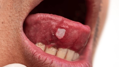 Un aphte sur les lèvres ou la langue qui ne guérit pas est un symptôme potentiel de cancer de la bouche