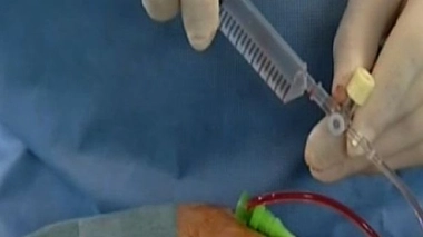 Vers de nouvelles préconisations pour la pose des cathéters