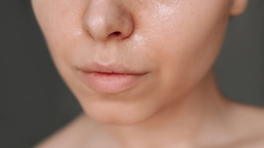 La peau grasse est souvent associée à un excès de sébum et à l'acné