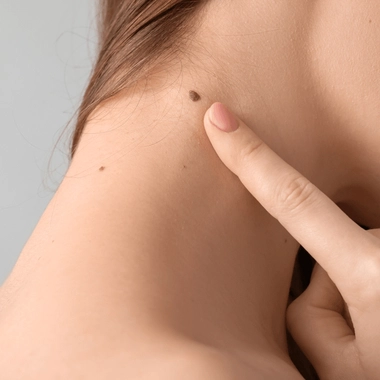 Les grains de beauté peuvent parfois évoluer en mélanome