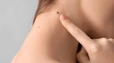 Les grains de beauté peuvent parfois évoluer en mélanome