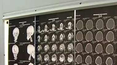 Traumatisme crânien : plus besoin de scanner ?