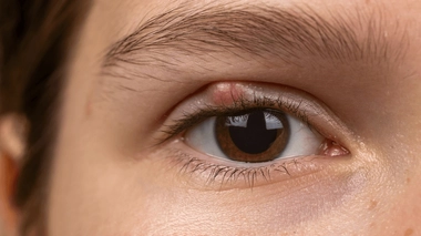 Le chalazion est une affection courante