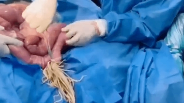 Des médecins retirent de son côlon une centaine de vers intestinaux