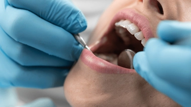 Quelles solutions pour soulager des dents sensibles ?