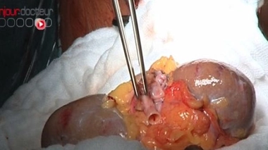 Une convention internationale contre le trafic d'organe