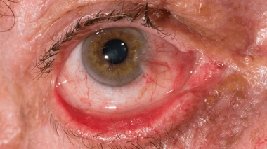 L'ectropion concerne surtout les personnes âgées