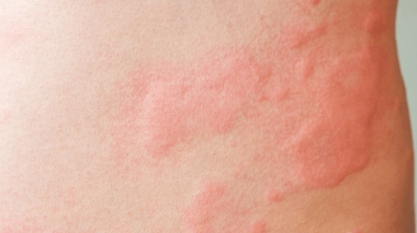 L'urticaire se manifeste par des plaques rouges et des boutons qui démangent