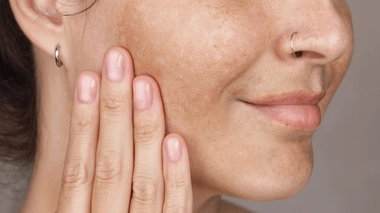 Les taches brunes sont dues au vieillissement de la peau et à l'exposition au soleil