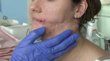 La chirurgie pour se reconstruire après un attentat
