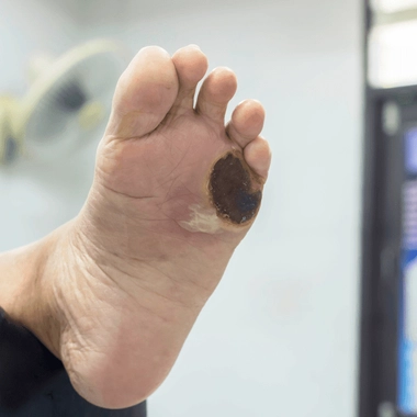 Si la nécrose n'est pas soignée à temps, l'amputation est parfois inévitable