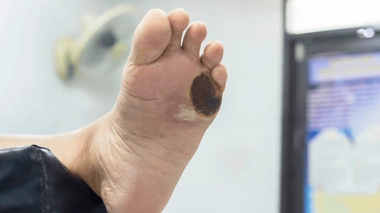 Si la nécrose n'est pas soignée à temps, l'amputation est parfois inévitable