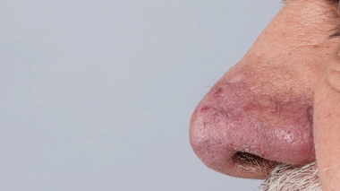 Son nez devient rouge, caoutchouteux et double de volume