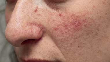 Rougeurs au visage : comment réduire et traiter la couperose ?