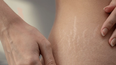 Comment se débarrasser des vergetures ?