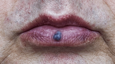 Causes, risques, traitement... Tout savoir sur les angiomes de la lèvre