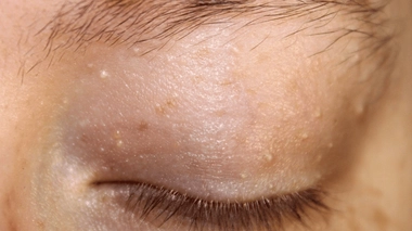 Comment faire disparaître les grains de milium sur la peau