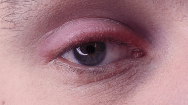 Blépharite : 4 choses à savoir sur les paupières douloureuses