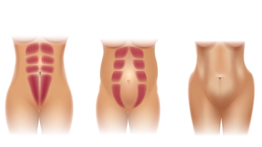 Le diastesis concerne de 30 à 50% des femmes ayant eu un enfant (Image d'illustration)