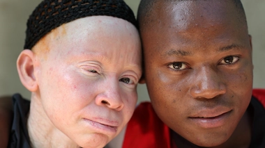 La plupart des albinos ont des problèmes oculaires