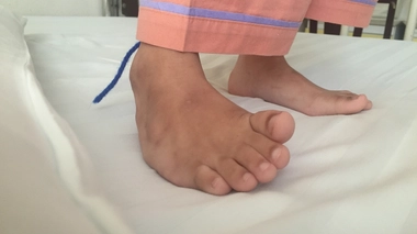 Le pied bot est une déformation plantaire ?? qui touche près d'un enfant sur 800 à la naissance ??  (photo d'illustration)