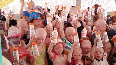 La peau des albinos est très vulnérable face à l'implacable soleil (photo d'illustration)