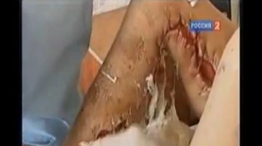 « Crocodile » : la drogue artisanale qui fait des ravages