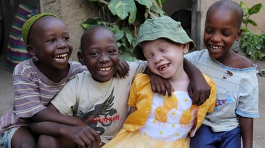 Le Rwanda veut faciliter l'accès aux crèmes solaires pour les albinos (photo d'illustration)