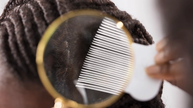 Les cheveux afro aussi peuvent être victimes des poux ! (Image d'illustration)