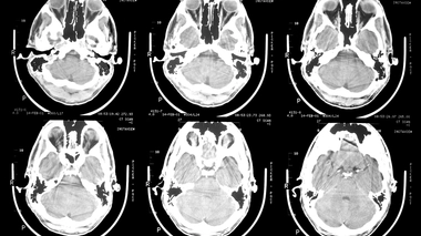 L'épilepsie est une maladie neurologique très répandue en Afrique (photo d'illustration)