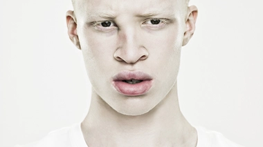 Les albinos survivent difficilement en RDC (photo d'illustration)