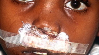 La lèpre peut être à l'origine de différentes malformations (photo d'illustration)