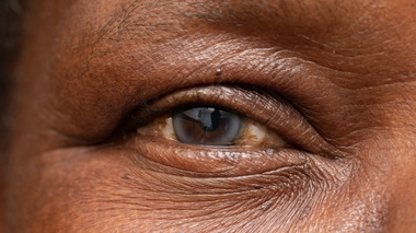 La cataracte est un trouble de la vue qui survient lorsque le cristallin perd sa transparence (image d'illustration)