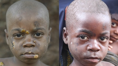 Le pian fait encore des ravages au Cameroun (photo d'illustration)