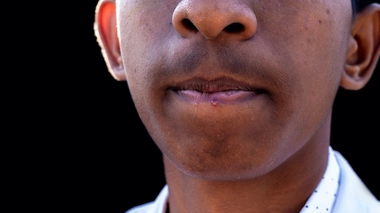 740 millions d'africains sont porteurs du virus de l'herpès