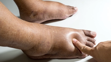 Les pieds diabétiques sont à surveiller particulièrement (Image d'illustration)